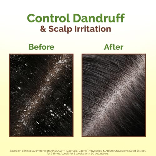 Mamaearth Lemon Anti-Dandruff Hair Oil for Flaky Scalp 100ml|Scalp Irritation Relief|Nourishes Scalp & Hair|Contains Lemon, Ginger, Apiscalp (Clinically Proven), Svetakutaja Oil, Neem, Salicylic Acid - Image 6