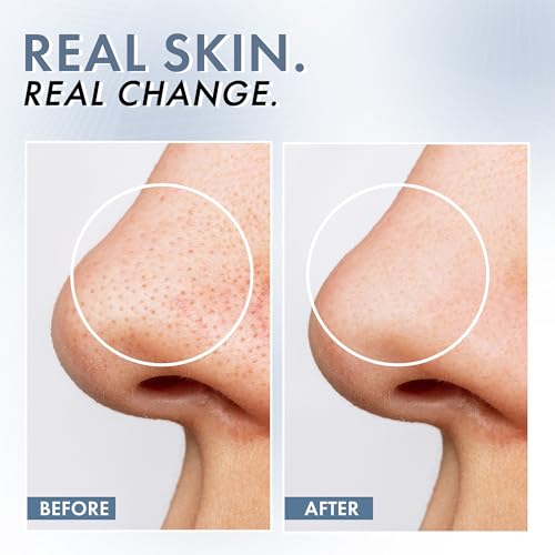 ThriveCo Niacinamide Serum with Zinc PCA | Reduces Acne Marks & Blemishes | Minimizes Pores | Oil Control Face Serum for Oily Skin | For Men & Women | 30ml - Image 5