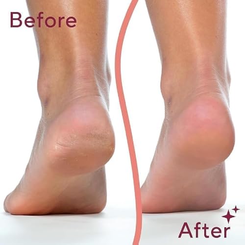 callus remover for feet dead